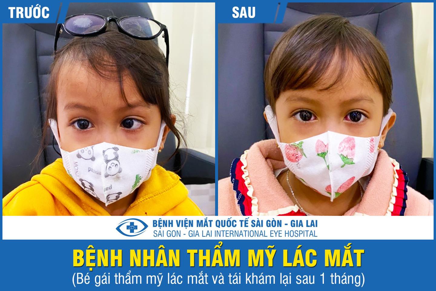 bệnh nhân trước và sau khi phẫu thuật lác lé