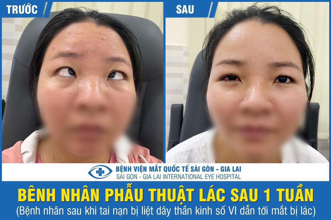 bệnh nhân phẫu thuật lác lé thành công tại gia lai