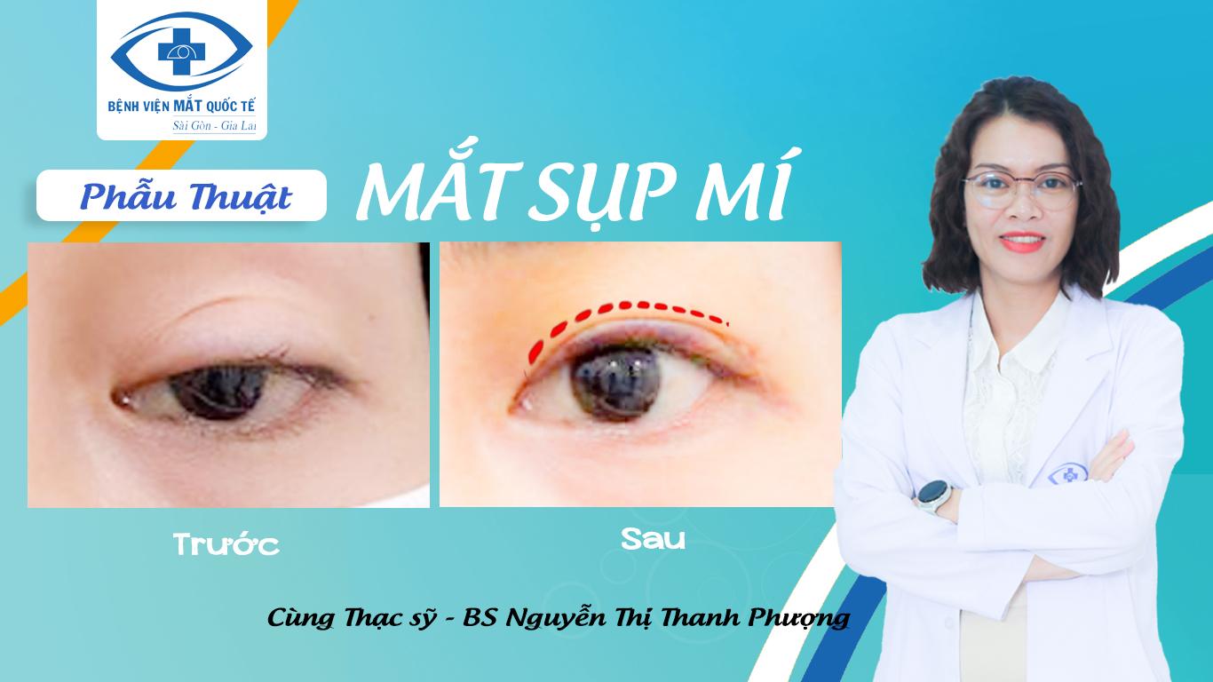 mat-sup-mi-thumbnail