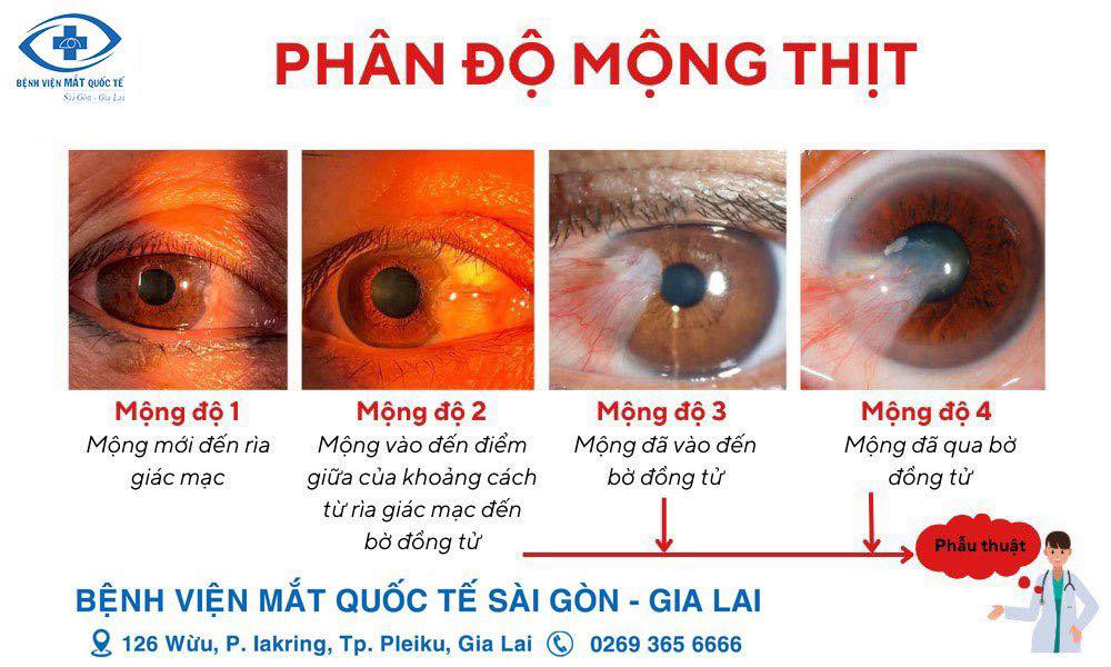 phân độ mộng thịt