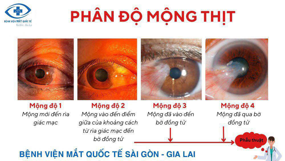 phan-do-mong-thit-qCvw9