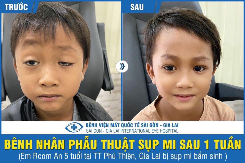 phau-thuat-sup-mi-gia-lai