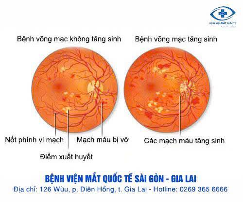 thoai hoa diem vang