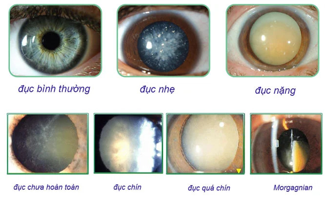 phân loại đục thủy tinh thể