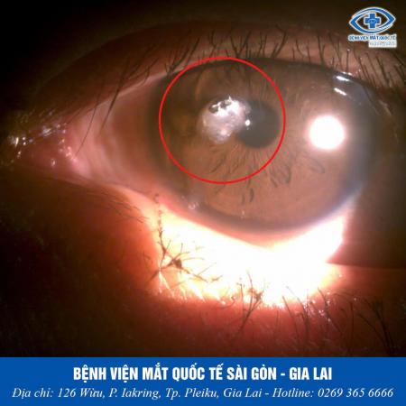CẤP CỨU CHẤN THƯƠNG MẮT DO TAI NẠN – GIÀNH GIẬT ÁNH SÁNG TỪ RANH GIỚI MÙ LÒA