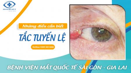 TẮC LỆ ĐẠO  - Tắc tuyến lệ: Những điều cần biết