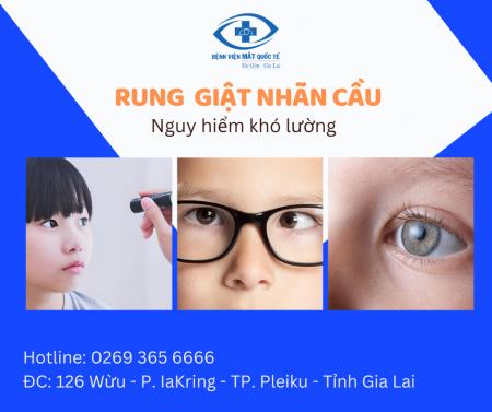 Rung giật nhãn cầu: Phân loại, nguyên nhân và cách điều trị