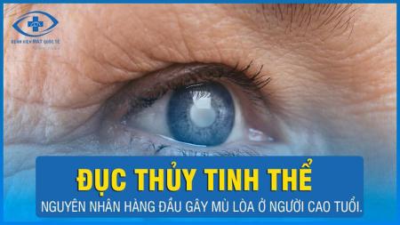 Bệnh đục thủy tinh thể